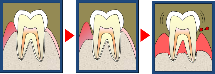 歯周病とは