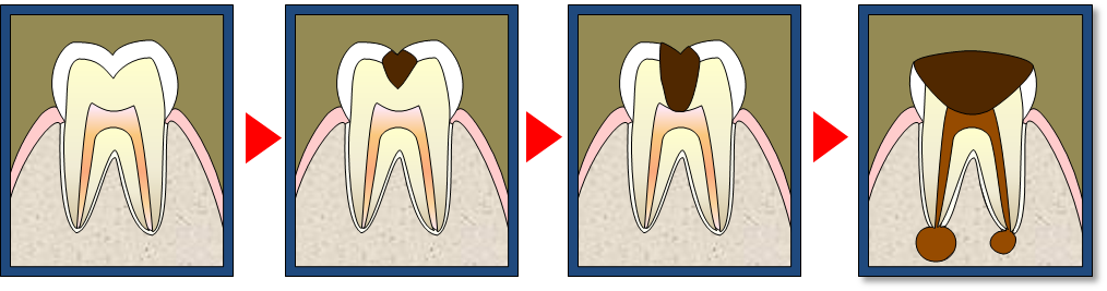 むし歯の進行