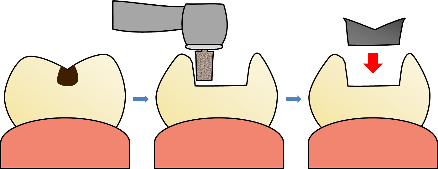 インレー修復治療