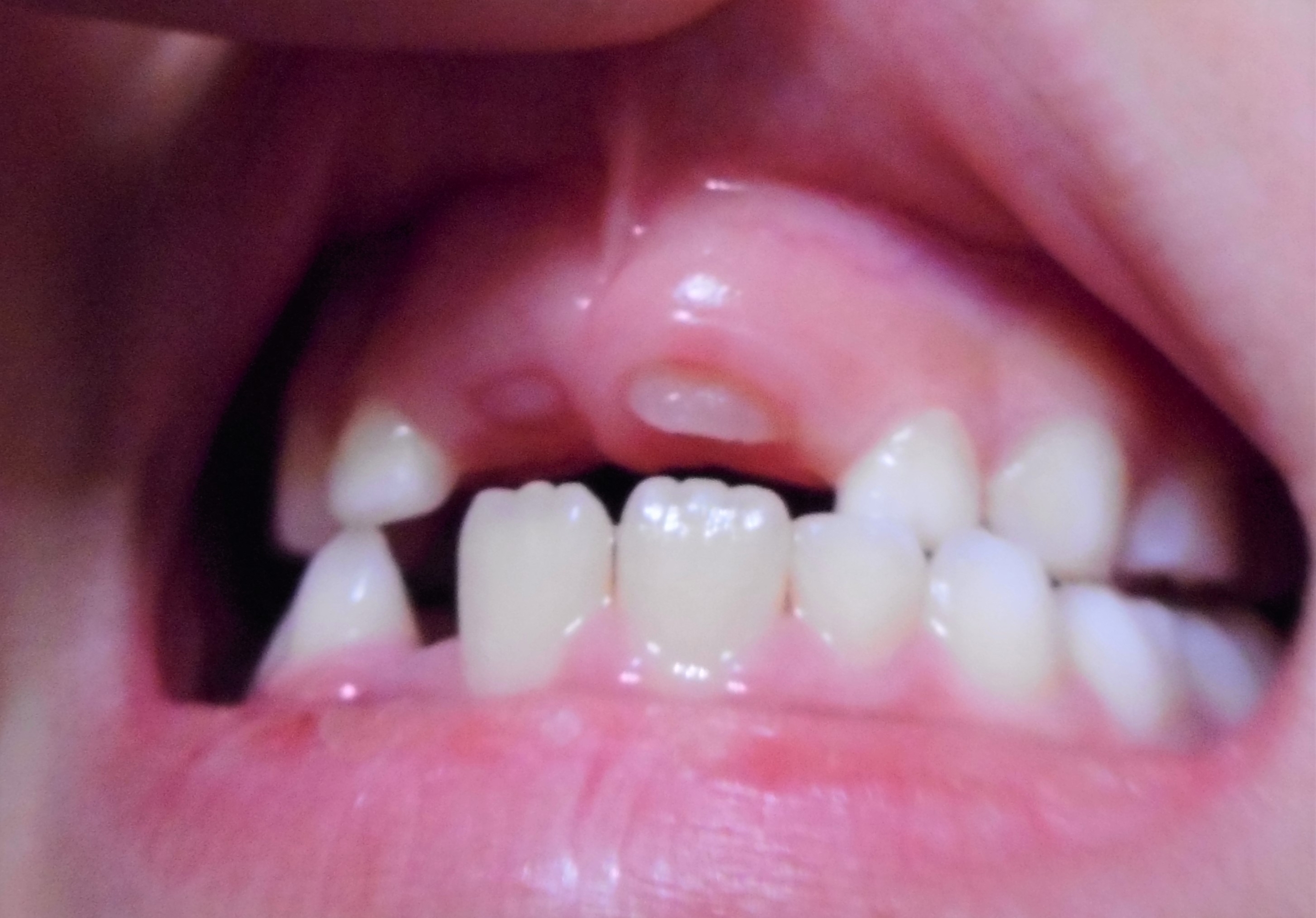 前歯の生え変わり