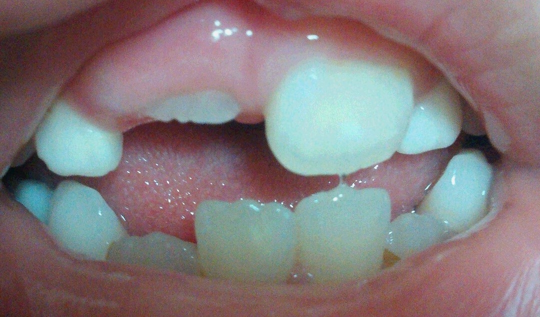 6歳の息子　右上中切歯の萌出