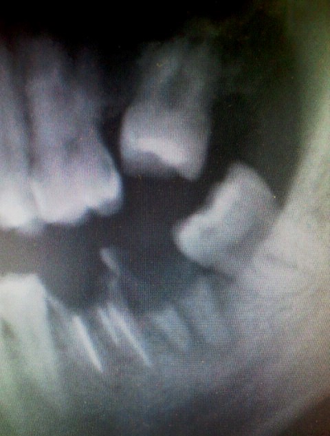 歯の移植術前