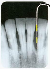 歯周ポケット診査レントゲン