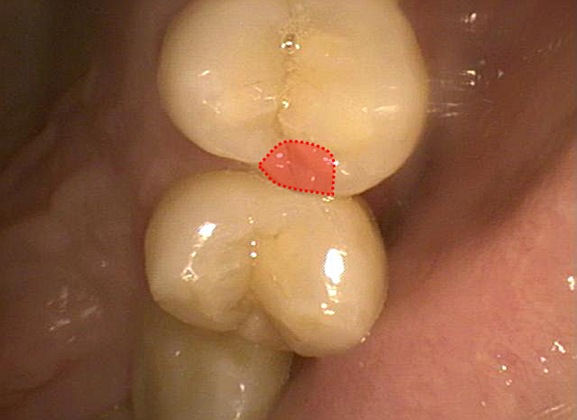 ４，５間レジン充填前むし歯印
