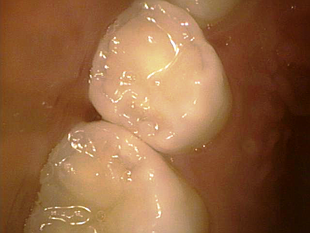 乳歯歯間のむし歯
