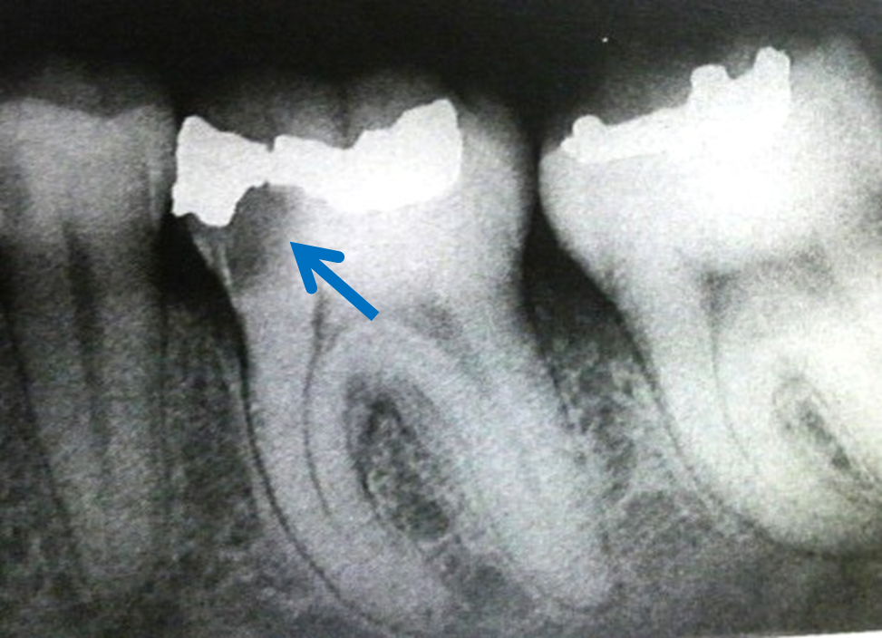 二次齲蝕レントゲン
