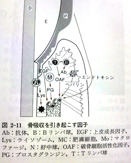 歯周病の説明